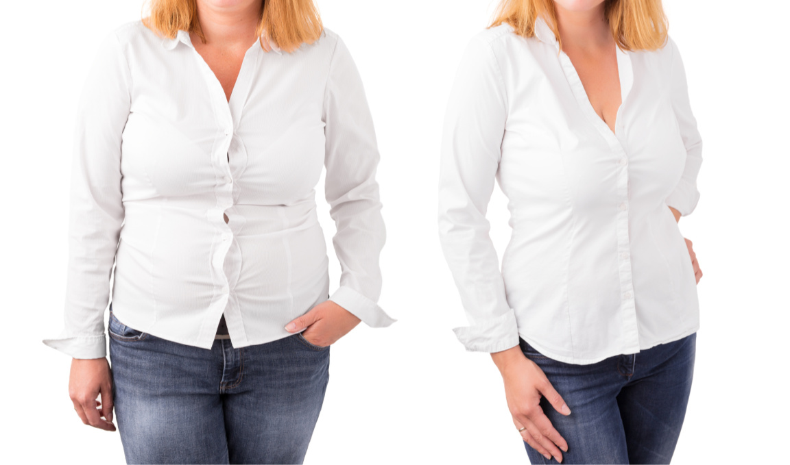 Post Bariatric Surgery Post Bariatric Surgery