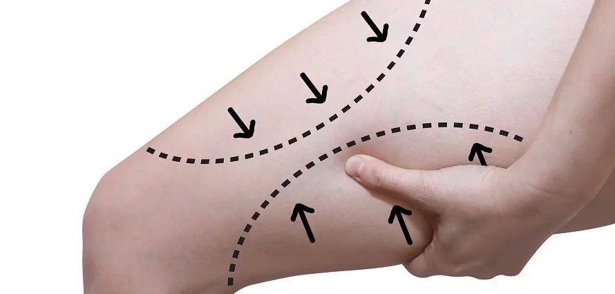 uyluk germe Thigh Lift Surgery - Op. Dr. Ertan Günal Gaziantep