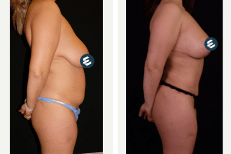 mommy-makeover-before-and-after Annelik Estetiği - Op. Dr. Ertan Günal Gaziantep