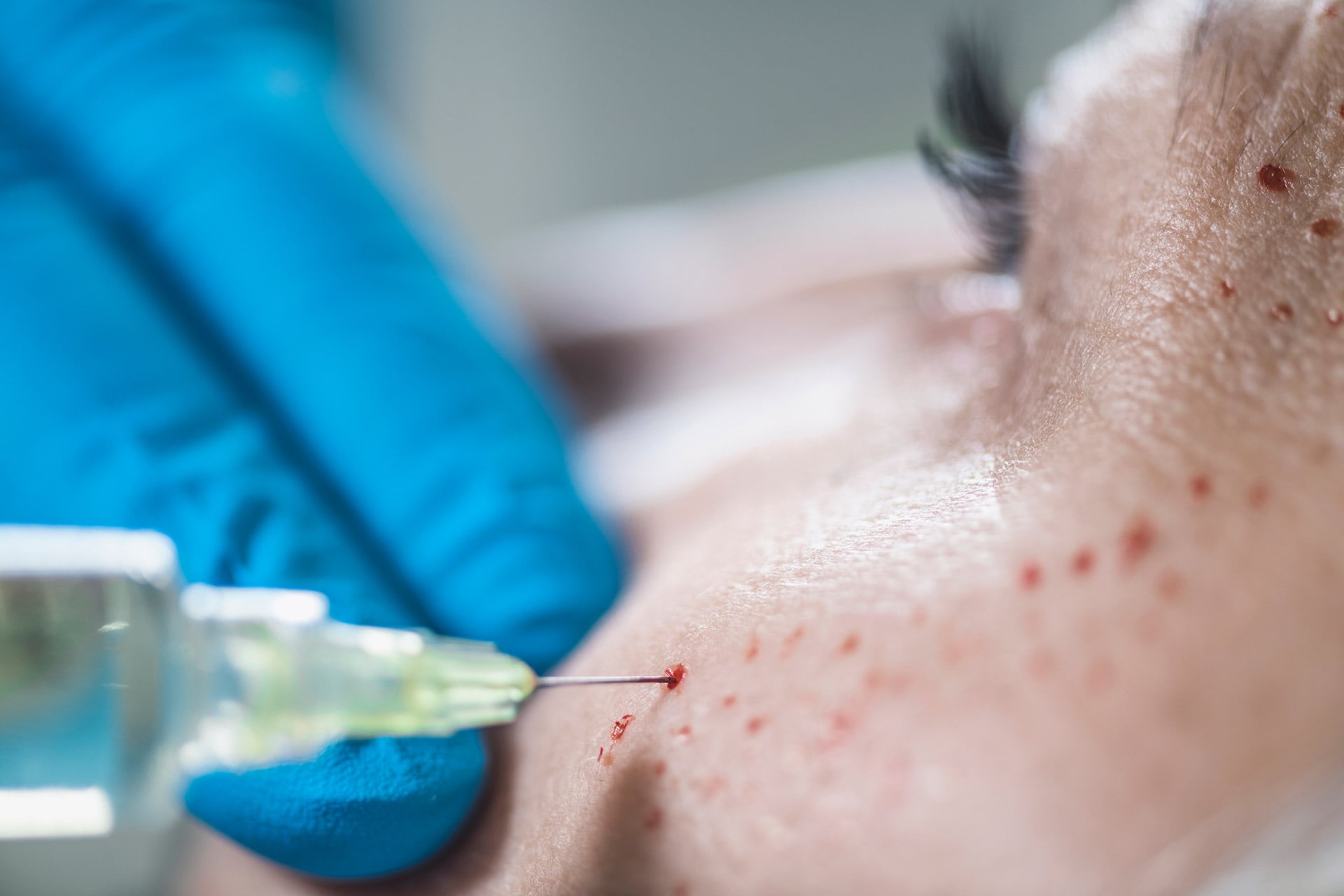 prp-face-cosmetic PRP Tedavisi - Op. Dr. Ertan Günal Gaziantep
